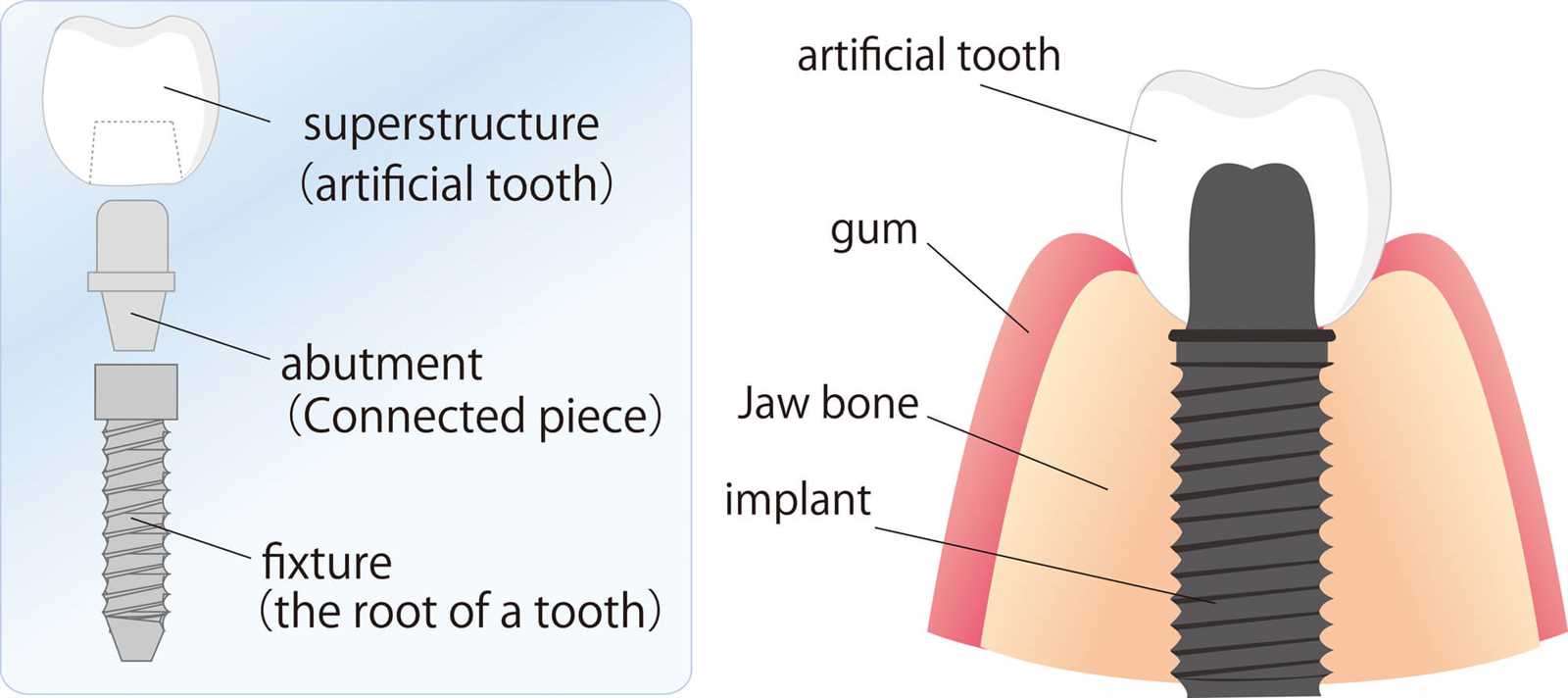 dental implant parts diagram