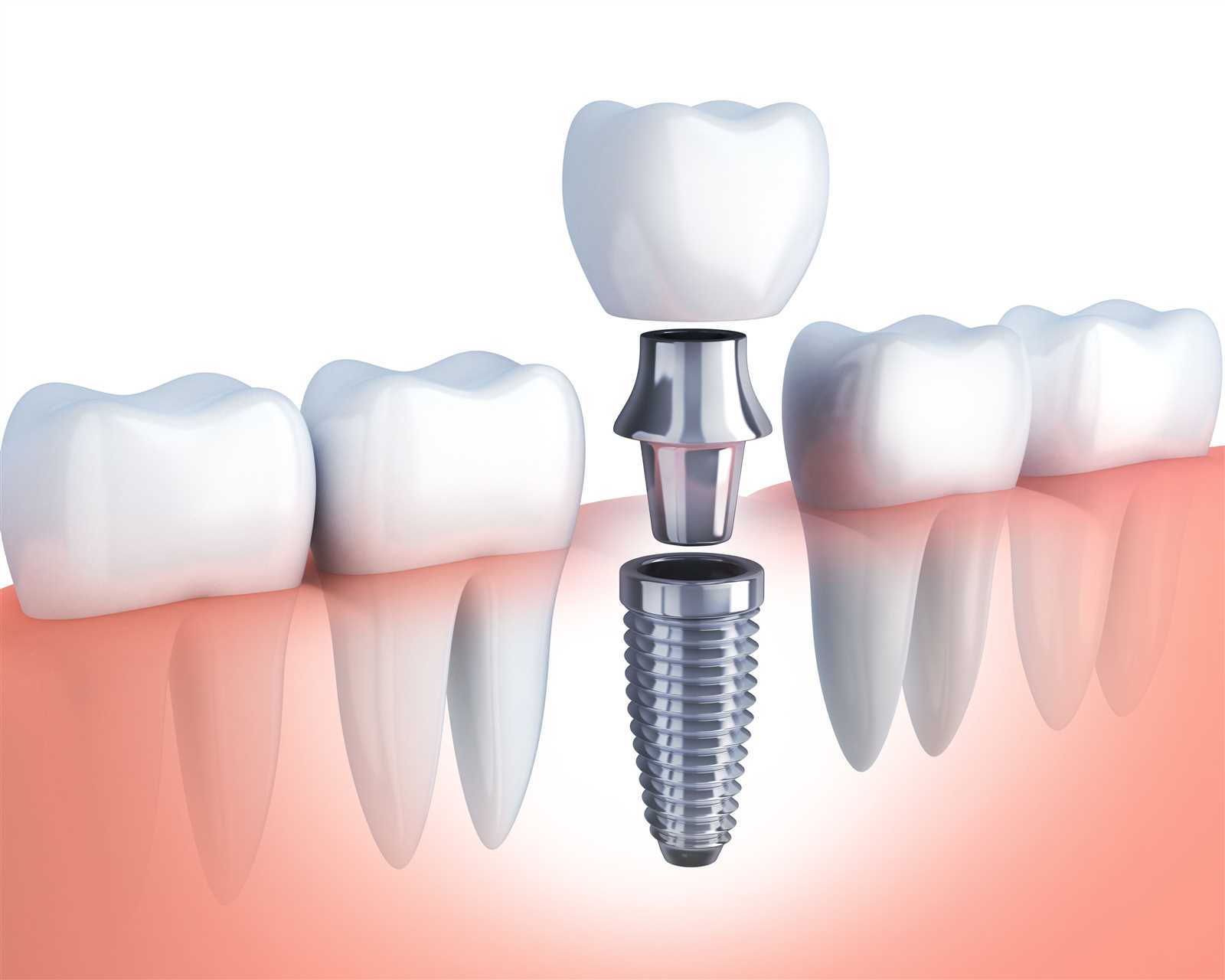 dental implant parts diagram