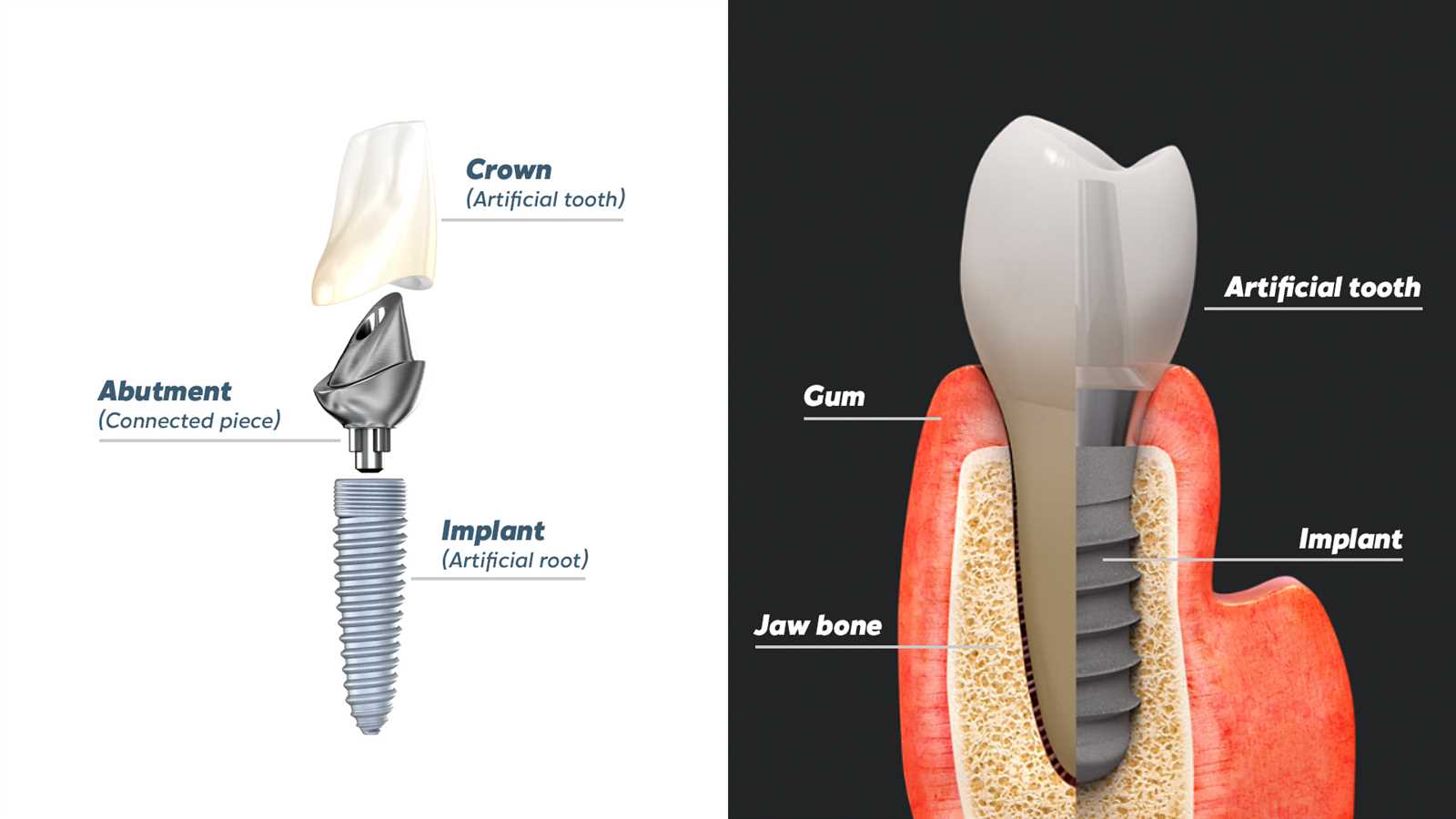 dental implant parts diagram