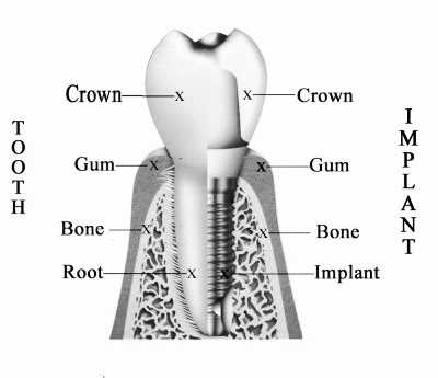 dental implant parts diagram