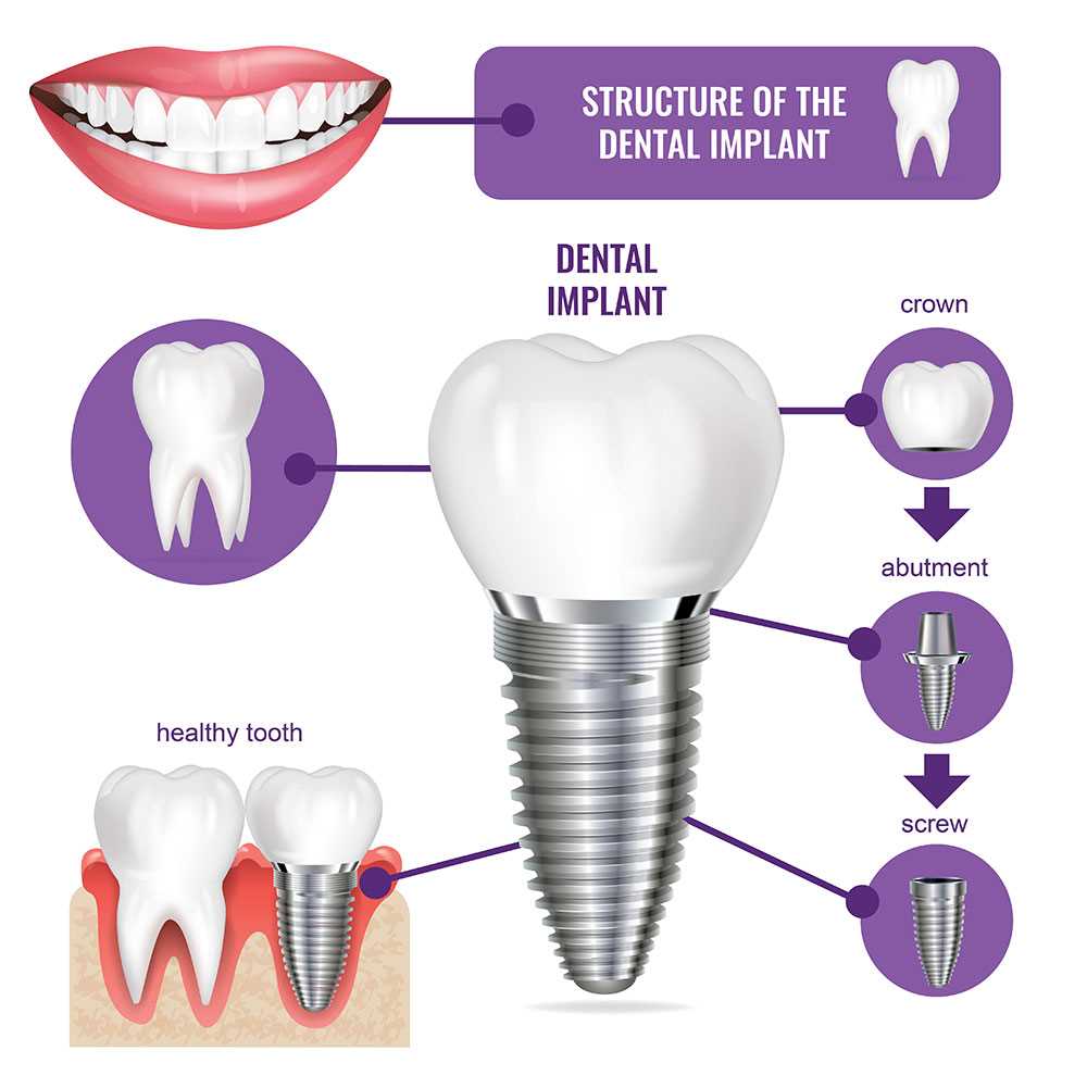 dental implant parts diagram