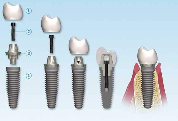 dental implant parts diagram