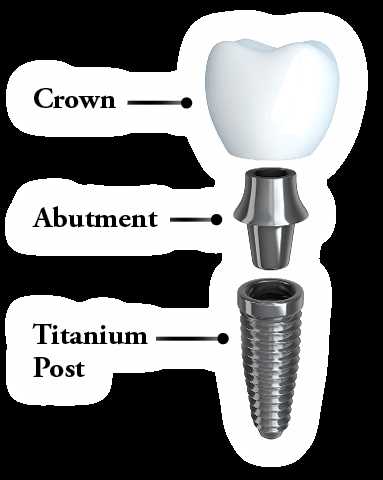 dental implant parts diagram