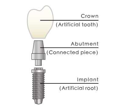 dental implant parts diagram